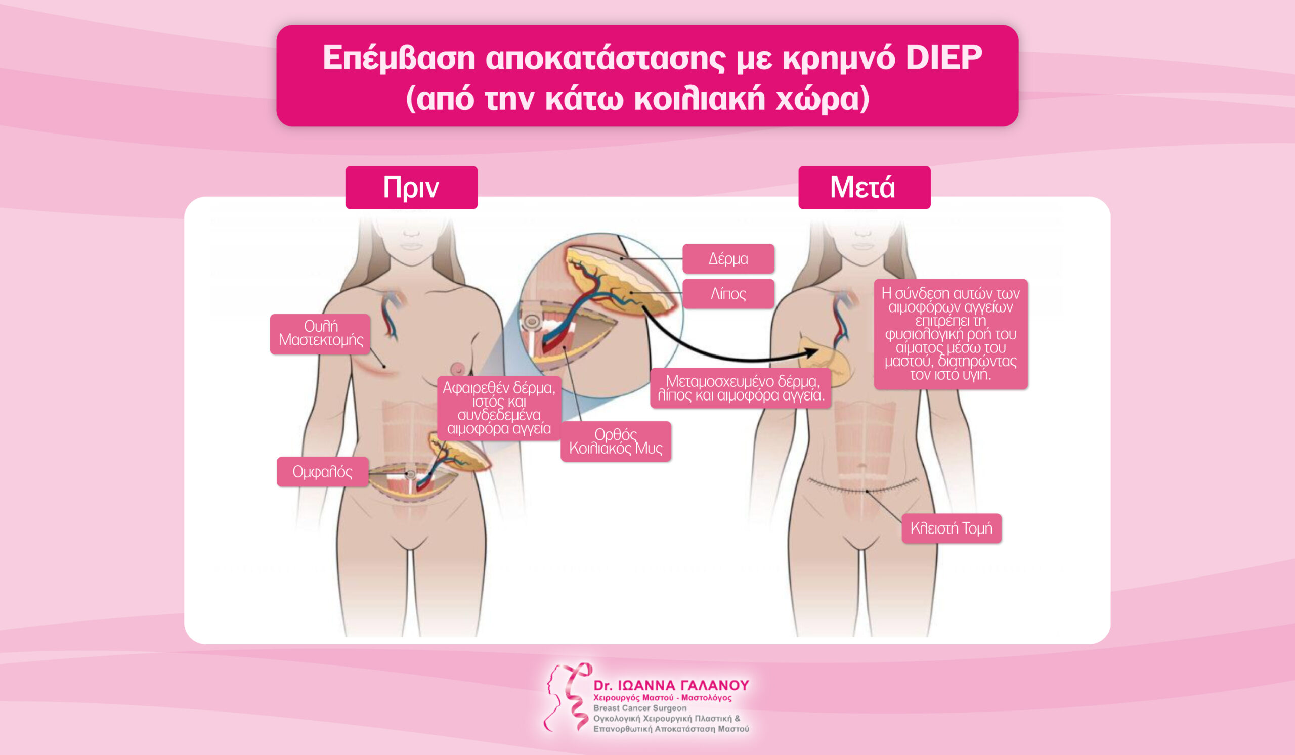 επανορθωτική αποκατάσταση D.I.E.P